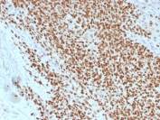 IHC testing of Ewing's sarcoma stained with recombinant NKX2.2 antibody (clone rNX2/1523). Required HIER: boil tissue sections in 10mM citrate buffer, pH 6, for 10-20 min followed by cooling at RT for 20 min.