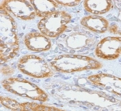 IHC testing of FFPE human renal cell carcinoma with CD61 antibody (clone PMGP3-1R). Required HIER: boil tissue sections in 10mM Tris with 1mM EDTA, pH9, for 10-20 min followed by cooling at RT for 20 min.