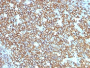 IHC testing of FFPE human tonsil tissue with recombinant CD20 antibody (clone rIGEL/773). Required HIER: steam section in pH6 citrate buffer for 20 min.