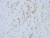 IHC testing of FFPE human hepatic carcinoma with TdT antibody (clone M12P4H2). Required HIER: boil tissue sections in 10mM citrate buffer, pH6, for 10-20 min followed by cooling at RT for 20 min.