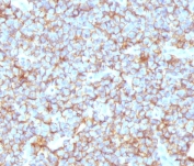 IHC testing of FFPE human Ewing's sarcoma with recombinant CD99 antibody (clone CDLA99-2R). Required HIER: steam sections in 10mM Citrate buffer, pH 6.0, for 10-20 min.