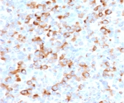 IHC staining of FFPE human melanoma with recombinant Tyrosinase antibody (clone TRSN1-2R). Required HIER: boil tissue sections in 10mM Tris with 1mM EDTA, pH9, or 10mM citrate buffer, pH6, for 10-20 min followed by cooling at RT for 20 min.