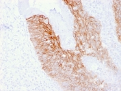 IHC staining of FFPE human cervix carcinoma with CD44v6 antibody (clone 2F10). HIER: boil tissue sections in pH 9 10mM Tris with 1mM EDTA for 20 min and allow to cool before testing.