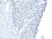 IHC testing of FFPE human endometrial carcinoma with Cyclin A2 antibody. Required HIER: steam section in pH6 citrate buffer for 20 min and allow to cool prior to staining.
