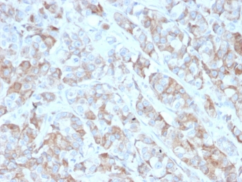 IHC testing of FFPE human gastric carcinoma with BCMA antibody (clone BCMA/2366). HIER: boil tissue sections in pH6, 10mM citrate buffer, for 10-20 min followed by cooling at RT for 20 min.