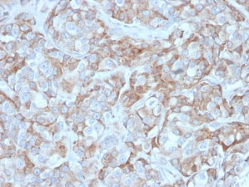 IHC testing of FFPE human gastric carcinoma with BCMA antibody (clone BCMA/2366). HIER: boil tissue sections in pH6, 10mM citrate buffer, for 10-20 min followed by cooling at RT for 20 min.