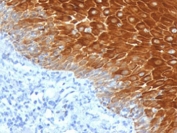IHC testing of FFPE human basal cell carcinoma with KRT6 antibody (clone CTKN6-1). Required HIER: boil tissue sections in pH6, 10mM citrate buffer, for 10-20 min followed by cooling at RT for 20 min.