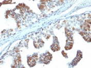 IHC testing of human prostate carcinoma with PTEN antibody (clone PTEN/2110). Required HIER: boil tissue sections in 10mM citrate buffer, pH 6, for 10-20 min followed by cooling at RT for 20 min.