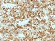 IHC testing of human melanoma with PMEL17 antibody (clone PMEL/2037). Required HIER: boil tissue sections in 10mM citrate buffer, pH 6, for 10-20 min followed by cooling at RT for 20 min.