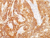 IHC testing of FFPE human lung squamous cell carcinoma with recombinant EGFRvIII antibody (clone GFR/2600R). Required HIER: boiling tissue sections in pH 9 10mM Tris with 1mM EDTA for 10-20 min and allow to cool prior to testing.