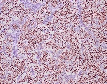 IHC staining of FFPE human seminoma tissue with OCT4 antibody (clone OCT4/6847R) at 2ug/ml. HIER: boil tissue sections in pH 9 10mM Tris with 1mM EDTA for 20 min and allow to cool before testing.~