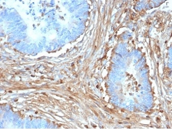 IHC staining of FFPE human colon carcinoma with Fibrillin 1 antibody (clone FBN1/6933). HIER: boil tissue sections in pH 9 10mM Tris with 1mM EDTA for 20 min and allow to cool before testing.~