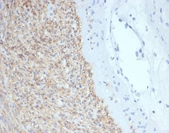 IHC staining of FFPE human gastrointestinal stromal tumor (GIST) with SCFR antibody (clone C117/7119) at 2ug/ml. HIER: boil tissue sections in pH 9 10mM Tris with 1mM EDTA for 20 min and allow to cool before testing.
