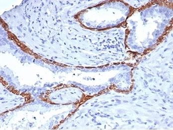 IHC staining of FFPE human prostate tissue with Cytokeratin 14 antibody (clone KRT14/4131). HIER: boil tissue sections in pH 9 10mM Tris with 1mM EDTA for 20 min and allow to cool before testing.~