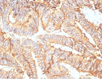 IHC staining of FFPE human colon carcinoma tissue with recombinant EpCAM antibody (clone rEGP40/7133). HIER: boil tissue sections in pH 9 10mM Tris with 1mM EDTA for 20 min and allow to cool before testing.~