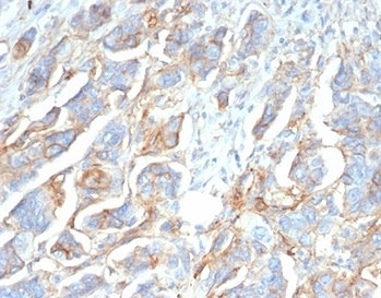 IHC staining of FFPE human ovarian carcinom