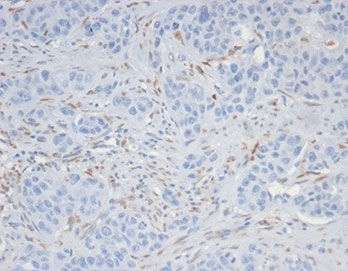 IHC staining of FFPE human kidney cancer tissue wit