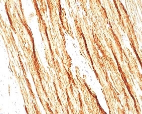 IHC staining of FFPE human colon tissue with recombinant Smoothelin antibody (clone SMTN/2320R). HIER: boil tissue sections in pH6, 10mM citrate buffer, for 20 min and allow to cool before testing.~