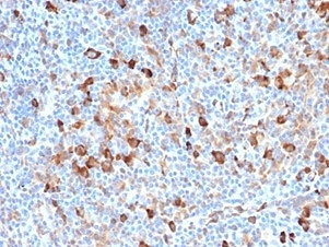 IHC staining of FFPE human Hodgkin's lymphoma with FSCN1 antibody (clone FSCN1/7209). HIER: boil tissue sections in pH 9 10mM Tris with 1mM EDTA for 20 min and allow to cool before testing.~