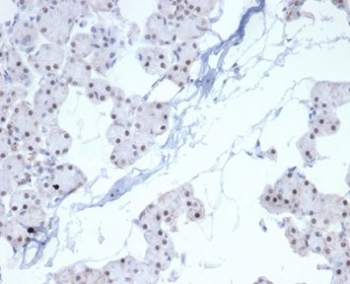 IHC staining of FFPE human renal cell carcinoma with recombinant PHOX2B antibody (clone PHOX2B/7161R). HIER: boil tissue sections in pH 9 10mM Tris with 1mM EDTA for 20 min and allow to cool before testing.~