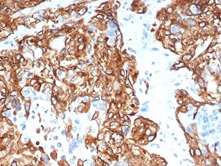 IHC staining of FFPE human lung carcinoma tissue wit