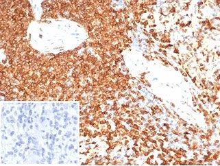 IHC staining of FFPE human spleen tissue with CD74 antibody (clone CLIP/7193) at 2ug/ml. Negative control inset: PBS used instead of primary antibody to control for secondary Ab binding. HIER: boil tissue sections in pH 9 10mM Tris with 1mM EDTA for 20 min and allow to cool before testing.~