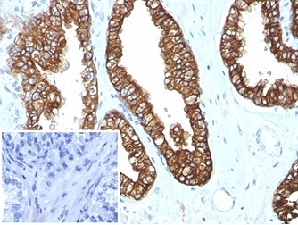 IHC staining of FFPE human prostate carcinoma tissue with recombinant Keratin 8/18 antibody (clone KRT8.18/4997R). Negative control inset: PBS used instead of primary antibody to control for secondary Ab binding. HIER: boil tissue sections in pH 9 10mM Tris with 1mM EDTA for 20 min and allow to cool before te