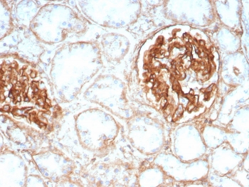 IHC staining of FFPE human colon carcinoma tissue with TAG-72 antibody (clone TAG72/8317R). HIER: boil tissue sections in pH 9 10mM Tris with 1mM EDTA for 20 min and allow to cool before testing.~