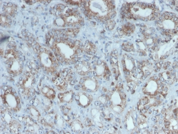 IHC staining of FFPE human breast cancer with Purified RET antibody (clone RET/2975). HIER: boil tissue sections in pH 9 10mM Tris with 1mM EDTA for 20 min and allow to cool before testing.~