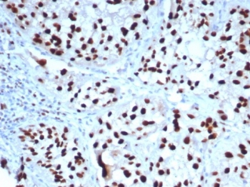 IHC staining of FFPE human bladder tissue with GATA-3 antibody (clone GATA3/7685R). HIER: boil tissue sections in pH 9 10mM Tris with 1mM EDTA for 20 min and allow to cool before testing.~