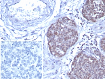 IHC staining of FFPE human ovarian cancer tissue with GATA-3 antibody (clone GATA3/7686R). Inset: PBS used in place of primary Ab (secondary Ab negative control). HIER: boil tissue sections in pH 9 10mM Tris with 1mM EDTA for 20 min and allow to cool before testing.~