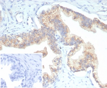 IHC staining of FFPE human prostate carcinoma tissue with PTEN antibody (clone PTEN/7345) at 2ug/ml. Inset: PBS used in place of primary Ab (secondary Ab negative control). HIER: boil tissue sections in pH 9 10mM Tris with 1mM EDTA for 20 min and allow to cool before testing.~