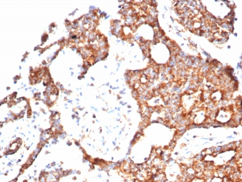IHC staining of FFPE human prostate carcinoma tissue with PTEN antibody (clone PTEN/7344) at 2ug/ml. Inset: PBS used in place of primary Ab (secondary Ab negative control). HIER: boil tissue sections in pH 9 10mM Tris with 1mM EDTA for 20 min and allow to cool before testing.~