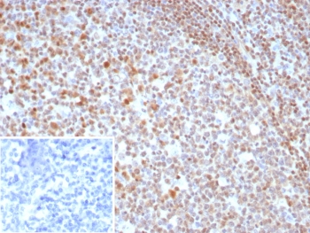 IHC staining of FFPE human tonsil tissue with MGMT antibody (clone MGMT/8319R). Inset: PBS used in place of primary Ab (secondary Ab negative control). HIER: boil tissue sections in pH 9 10mM Tris with 1mM EDTA for 20 min and allow to cool before testing.~