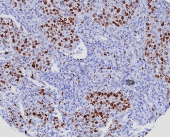 IHC staining of FFPE human lung adenocarcinoma. Ki67 antibody (clone MKI67/8005R). HIER: boil tissue sections in pH 9 10mM Tris with 1mM EDTA for 20 min and allow to cool before testing.~