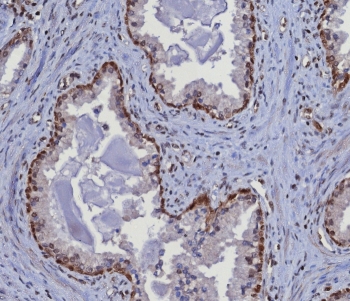 IHC staining of FFPE human prostate tissue with MGMT antibody (clone MGMT/8364R). HIER: boil tissue sections in pH 9 10mM Tris with 1mM EDTA for 20 min and allow to cool before testing.~