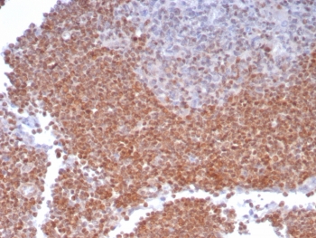 IHC staining of FFPE human lymph node tissue with MGMT antibody (clone MGMT/8186R). HIER: boil tissue sections in pH 9 10mM Tris with 1mM EDTA for 20 min and allow to cool before testing.~