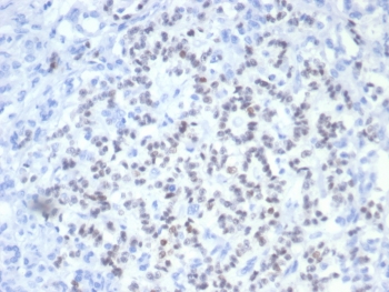 IHC staining of FFPE human pancreatic cancer with PAX6 antibody (clone PAX6/7708). HIER: boil tissue sections in pH 9 10mM Tris with 1mM EDTA for 20 min and allow to cool before testing.~