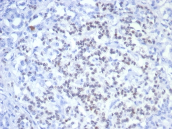 IHC staining of FFPE human pancreatic cancer with PAX6 antibody (clone PAX6/7707). HIER: boil tissue sections in pH 9 10mM Tris with 1mM EDTA for 20 min and allow to cool before testing.~