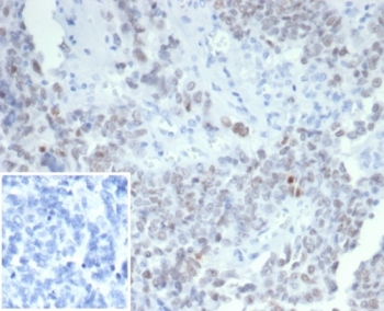 IHC staining of FFPE human ovarian carcinoma