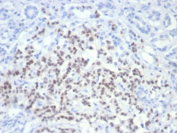 IHC staining of FFPE human pancreatic cancer with PAX6 antibody (clone PAX6/7705). HIER: boil tissue sections in pH 9 10mM Tris with 1mM EDTA for 20 min and allow to cool before testing.~