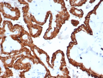 IHC staining of FFPE human kidney cancer with Crystallin Alpha B antibody (clone CRYAB/4665). HIER: boil tissue sections in pH 9 10mM Tris with 1mM EDTA for 20 min and allow to cool before testing.~