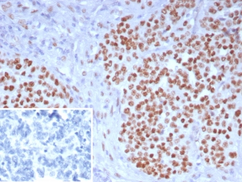 IHC staining of FFPE human ovarian carcinoma tissue with WT1 antibody (clone WT1/7715). Inset: PBS used in place of primary Ab (secondary Ab negative control). HIER: boil tissue sections in pH 9 10mM Tris with 1mM EDTA for 20 min and allow to cool before testing.~