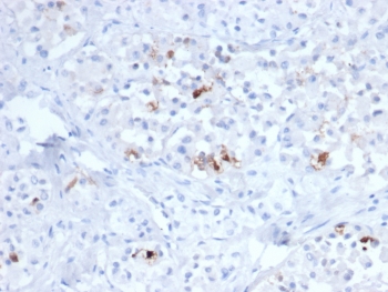 IHC staining of FFPE human pituitary tissue with FSH beta antibody (clone FSHB/6845). HIER: boil tissue sections in pH 9 10mM Tris with 1mM EDTA for 20 min and allow to cool before testing.~