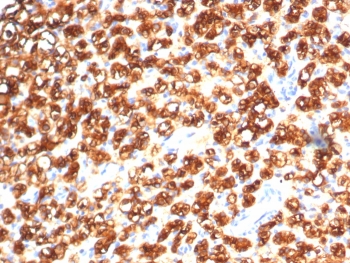 IHC staining of FFPE human kidney cancer with TPH1 antibody (clone TPH1/7662). HIER: boil tissue sections in pH 9 10mM Tris with 1mM EDTA for 20 min and allow to cool before testing.~