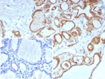 IHC staining of FFPE human thyroid tissue with Calcitonin antibody (clone CALCA/8639R). Inset: PBS used in place of primary Ab (secondary Ab negative control). HIER: boil tissue sections in pH 9 10mM Tris with 1mM EDTA for 20 min and allow to cool before testing.~