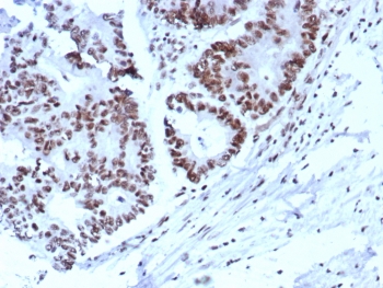 IHC staining of FFPE human colon. Strong nuclear staining using KIP2/8572 at 2ug/ml. HIER: boil tissue sections in pH 9 10mM Tris with 1mM EDTA for 20 min and allow to cool before testing.~