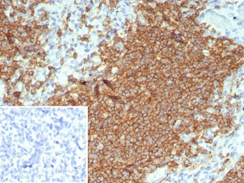 IHC staining of FFPE human tonsil tissue with CD20 antibody (clone rMS4A1/8044). Inset: PBS used in place of primary Ab (secondary Ab negative control). HIER: boil tissue sections in pH 9 10mM Tris with 1mM EDTA for 20 min and allow to cool before testing.~