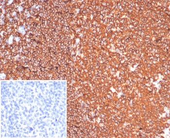 IHC staining of FFPE human tonsil tissue with CD20 antibody (clone MS4A1/6993R). Inset: PBS used in place of primary Ab (secondary Ab negative control). HIER: boil tissue sections in pH 9 10mM Tris with 1mM EDTA for 20 min and allow to cool before testing.~