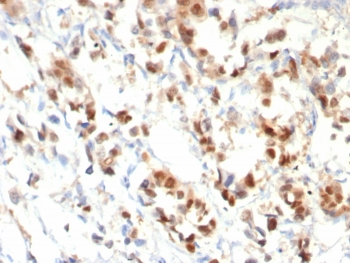 IHC staining of FFPE human breast cancer with PR antibody (clone PGR/8099R). HIER: boil tissue sections in pH 9 10mM Tris with 1mM EDTA for 20 min and allow to cool before testing.~